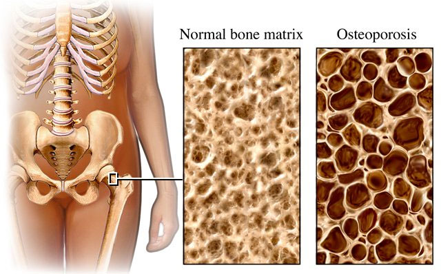 Phát hiện nhiều gene mới liên quan bệnh loãng xương