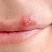 Chữa mụn rộp ở môi