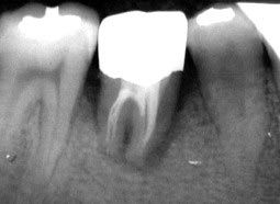 Lấy tế bào gốc từ mầm răng khôn