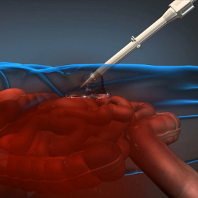 Bọt cầm máu nội thương