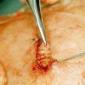 Phát hiện giòi ăn thịt sống dưới da người