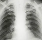Phát hiện thêm về virus EMC mới gây viêm phổi