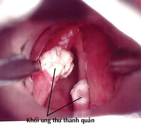 Phát minh test chẩn đoán 12 loại bệnh ung thư