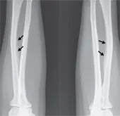 Uống quá nhiều trà làm xương bị vôi hóa