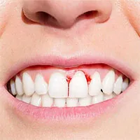 Nguyên nhân gây bệnh viêm răng lợi