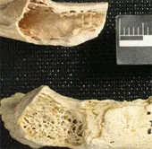 Chứng cứ bệnh ung thư ở người Neanderthal
