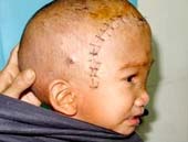 Mổ dị tật sọ mặt miễn phí cho trẻ em nghèo