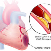 Hy vọng mới cho các bệnh nhân bị nhồi máu cơ tim