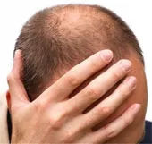 Đàn ông sợ hói đầu hơn bị "bất lực"