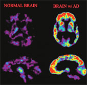 Mô hình mới nhất về nguyên nhân gây bệnh Alzheimer