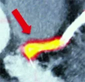 Có thể phát hiện nguy cơ đau tim bằng kỹ thuật chụp cắt lớp mới