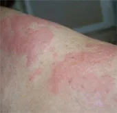 Sự thật ít biết về dị ứng