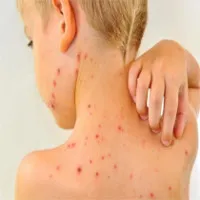 Con đường lây lan bệnh sởi