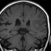 Dùng "virus tình dục" diệt u não
