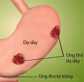 6 điều quan trọng về viêm loét dạ dày ai cũng cần biết