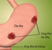 6 điều quan trọng về viêm loét dạ dày ai cũng cần biết