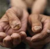 Làng ung thư ở Trung Quốc