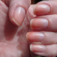 Những dấu hiệu bệnh thể hiện trên móng tay