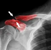 Tái tạo xương bằng các hạt nano từ tính
