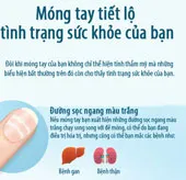 Móng tay tiết lộ sức khỏe của bạn