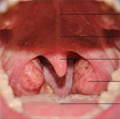 Hướng dẫn chăm sóc bệnh nhân sau cắt amidan