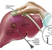 Việt Nam điều trị thành công ung thư gan bằng hạt vi cầu phóng xạ