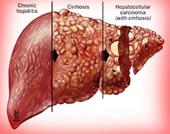 Ung thư gan - bệnh dễ chết khó phát hiện sớm