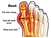 Bệnh Gout: Nguyên nhân, triệu chứng và cách điều trị