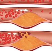 Đã có thuốc trị nhồi máu cơ tim và đột quỵ