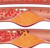 Đã có thuốc trị nhồi máu cơ tim và đột quỵ
