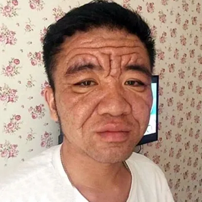 Tráng niên nhăn nheo như ông lão vì bệnh lạ