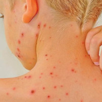 Lupus ban đỏ - Căn bệnh nguy hiểm ít được biết đến