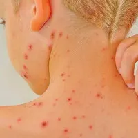 Lupus ban đỏ - Căn bệnh nguy hiểm ít được biết đến