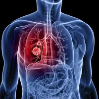 Giải mã lý do ngày càng có nhiều người bị ung thư
