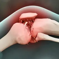 Xử trí đúng cách khi gặp nạn gây đứt chi