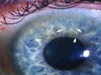 Biến chứng ở mắt do sử dụng kính áp tròng