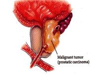 Phát hiện bộ gene độc đáo gây ung thư tiền liệt tuyến
