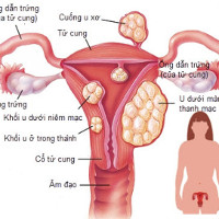 Nhiều phụ nữ bị u xơ tử cung mà không biết