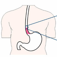 Uống quá nóng trên 65 độ C có thể gây ung thư thực quản