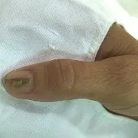Móng tay có sọc coi chừng u cuộn mạch