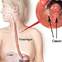 Nhật Bản công bố phương pháp mới điều trị ung thư thực quản