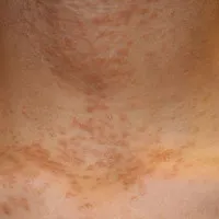Cẩn trọng bệnh về da do đi mưa và lội nước ngập