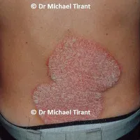 Những điều bạn cần biết về corticoid điều trị bệnh vảy nến