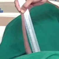 Chuyện lạ: Nam thanh niên "sót" chiếc đuôi dài gần 18cm