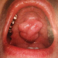 U lồi xương răng khiến nhiều người lo sợ bị ung thư