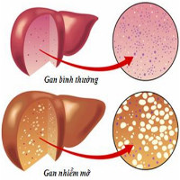 Cảnh giác dấu hiệu bệnh gan nhiễm mỡ