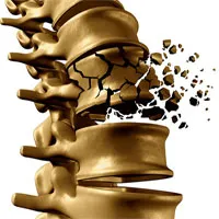 4 dấu hiệu "âm thầm" cảnh báo loãng xương