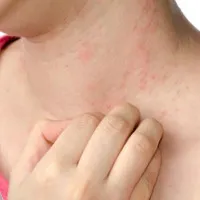 Vì sao bạn hay bị ngứa khi trời lạnh?
