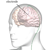 Kỹ thuật kích thích não sâu đã chữa được bệnh Parkinson, sắp tới có thể là Alzheimer và trầm cảm nữa