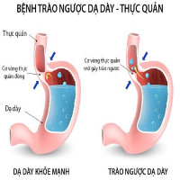 Cách ngăn chặn tình trạng trào ngược axit dạ dày